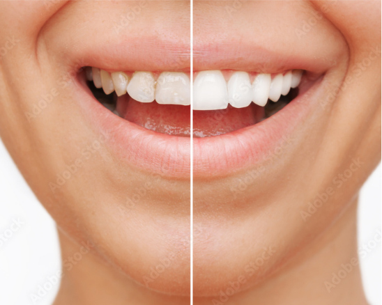 teeth whitening before and after