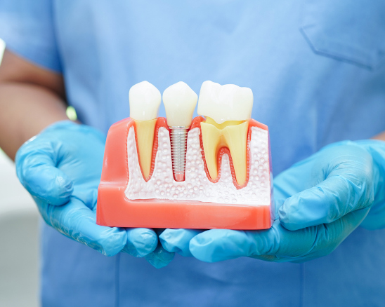 dental implants model held in dentist's hands