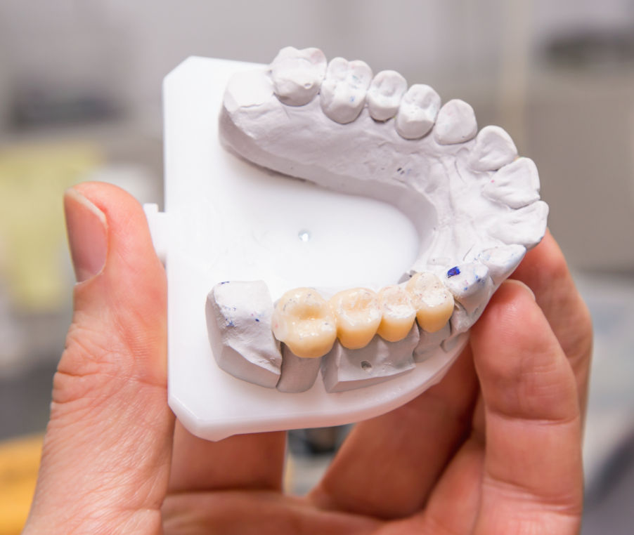 dental mold of mouth with crowns and a bridge