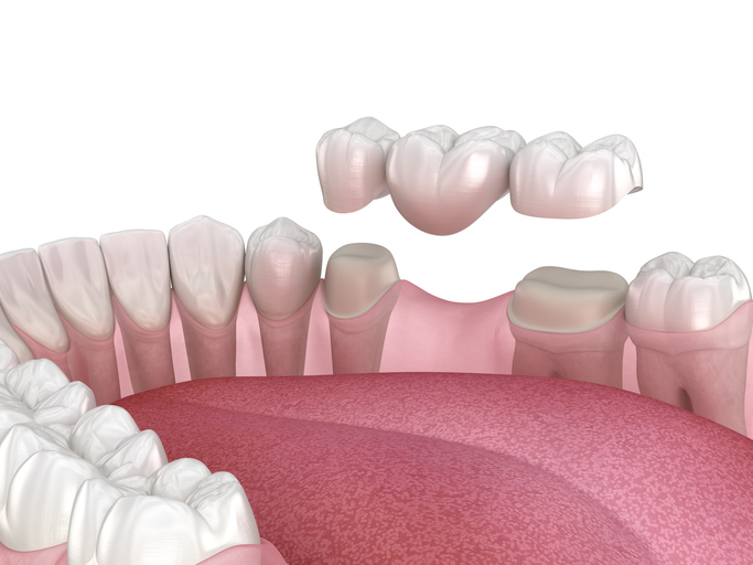 Dental bridge of 3 teeth over molar and premolar 3D illustration