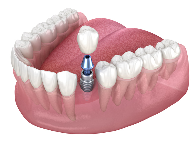 showing the dental implant parts and below the gum line 3D illustration